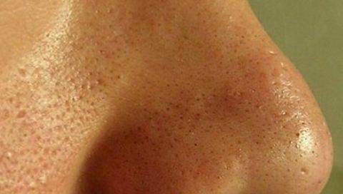 怎样有效收缩面部毛孔？分享5个方案，让肌肤变得更加紧致细腻！