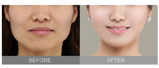 2023韩式隆鼻手术排行榜TOP10：哪些镇江整形美容医院在整形界备受瞩目？