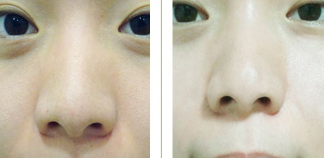 2023年北京哪家医院技术好的眼袋填充细胞治疗推荐