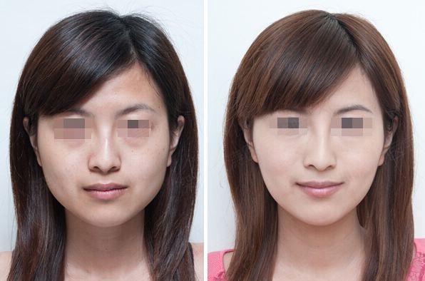 杭州瘦脸针美容诊所即将推出超值优惠，快来了解一下！