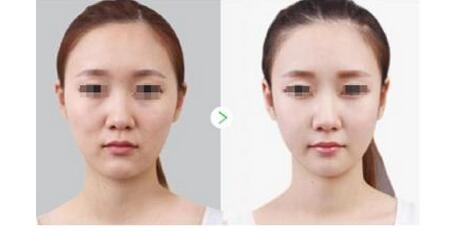 2023年武汉十家口碑好的水光针祛黑眼圈医疗美容医院