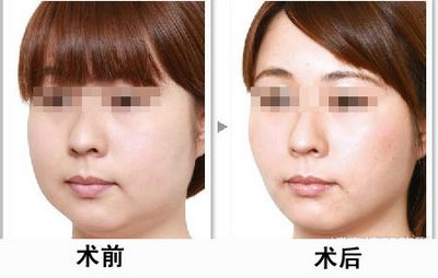 杭州Botox除皱针去皱整形医院推荐！2023年TOP10医院排行榜公布，网友一致推崇！