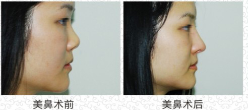 杭州哪些医疗美容医院的面部注射溶脂针口碑好？2023年清单公布！