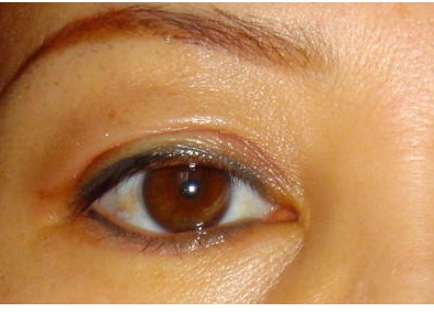 成都专业双眼皮整形医院推荐TOP8：华美紫馨、银海等为您打造完美双眼