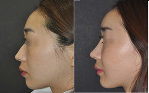 2023年度上海肋骨鼻整形美容医院权威排行榜揭晓！上海十家正规肋骨鼻整形美容医院一览
