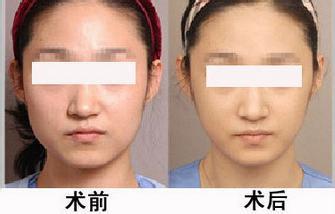 2023年，哪些北京医院能给你提供正规的自体脂肪注射眼底纹医疗美容服务？推荐最受口碑赞誉的美容医院列表！