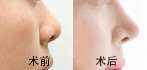 上海哪家医院治疗鼻唇沟效果比较好？2023上海鼻唇沟美容医院排名前10强公布！