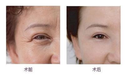 2023北京隆鼻医生大全：推荐首席鼻整形专家完美肖像，让你的鼻子更迷人