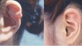 面部除皱有哪些方法？手术与非手术效果对比