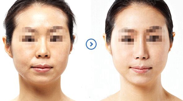 韩国raffine艾菲妮、BLS、缪慈整形外科皮肤管理项目价位解析