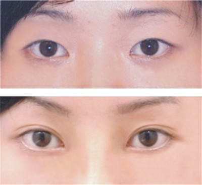 永州超微重睑术双眼皮价格趋势图剖析(2023永州超微重睑术双眼皮参考价为：4633元)