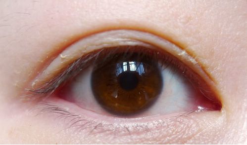 郑州手术改善眼睛细纹手术价格明细对比(2023郑州手术改善眼睛细纹参考价为：6358元)