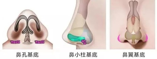 山西热拉提去除双下巴价目图表流出(2023山西热拉提去除双下巴参考价：4708-6261元)