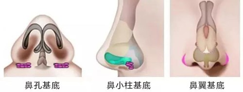 淮安颈部皱纹填充嗨体价格