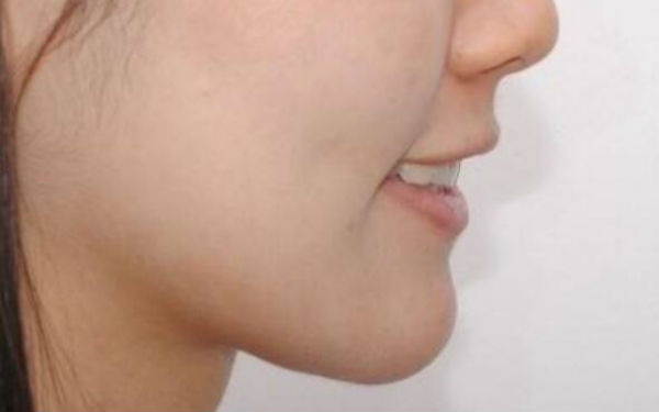 深圳玻尿酸隆鼻整形手术价格表隆重发布(2023深圳玻尿酸隆鼻整形手术参考价：4973-6556元)
