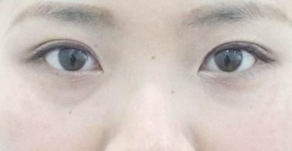 哈尔滨艺星整形医院专业双眼皮技术解析：郑皓均医生的创新术获赞