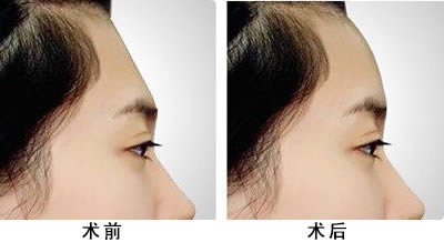 北京脸部除疤医生