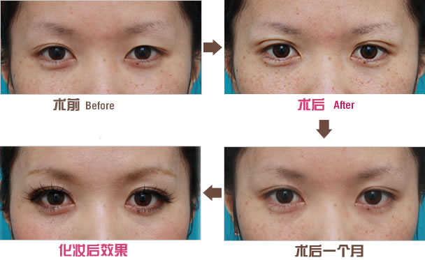 北京知名双眼皮修复医生推荐名单，2023最新版本+王世勇技术案例分享