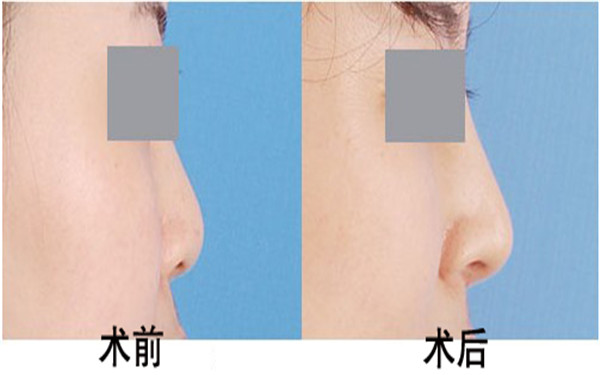 半永久纹发际线技术史三八医疗美容医院首席专家李珠贤创新方案