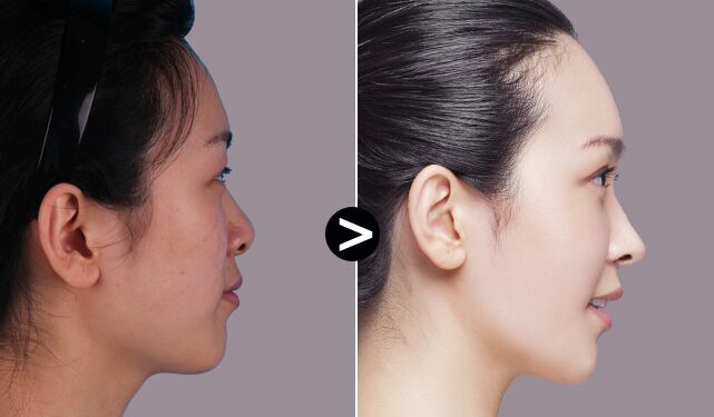 专业揭秘：谁是韩国鼻子整形界的超级名医？这些备受赞誉的医生会让你惊叹！