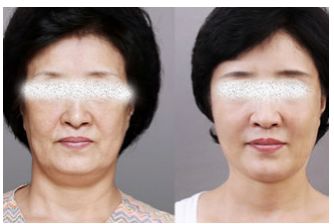 成都鼻整形领域备受赞誉的权威医生及就诊医院大揭秘！