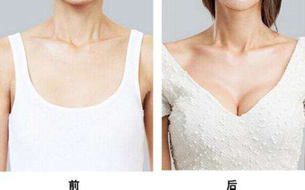 广州曙光医学美容医院颈部提升术效果优秀如何？