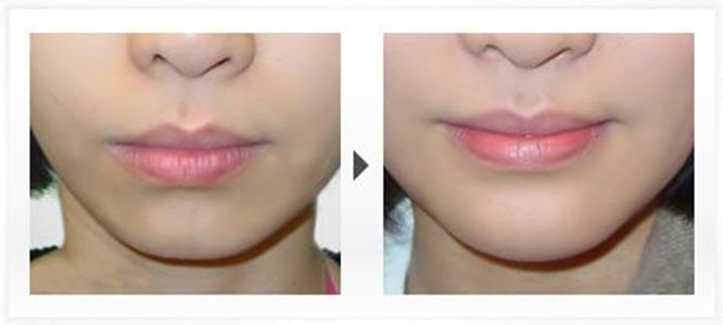 深圳阳光整形美容医院罗志敏的韩式隆鼻手术效果如何？