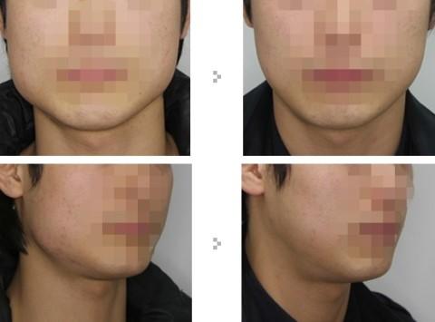 杭州冯啸医生：鼻基底填充技术案例分享，让您惊喜不已！